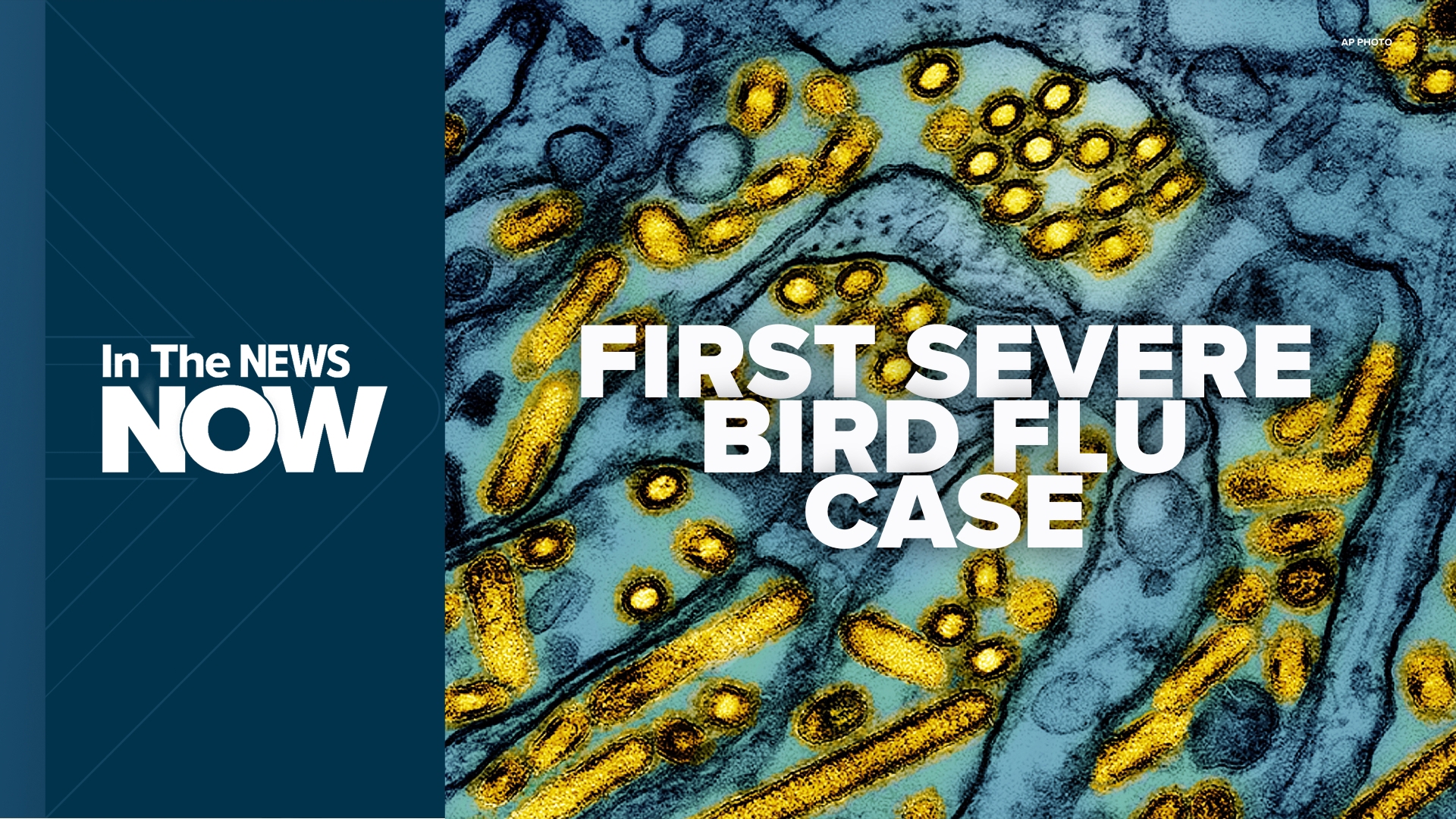 First severe human case of bird flu in U.S. In The News Now