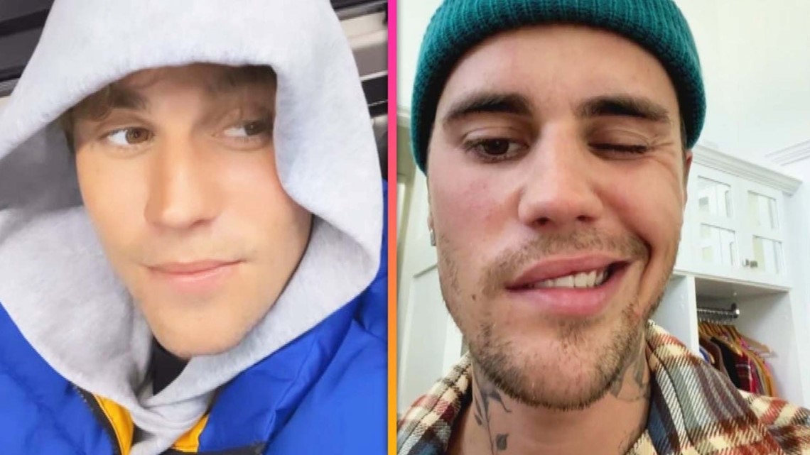 Justin Bieber Proudly Shares Facial Mobility Progress After Ramsay Hunt