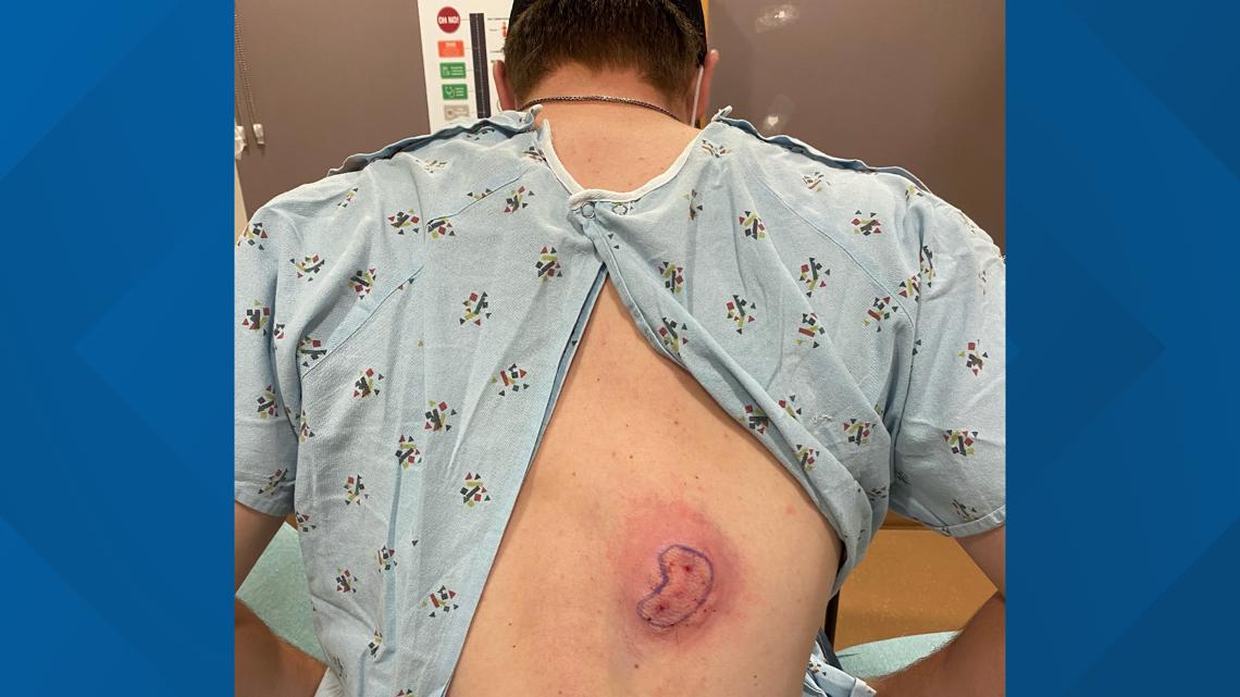 Bear climbs tree, bites Wisconsin deer hunter in the back - Vimarsana News