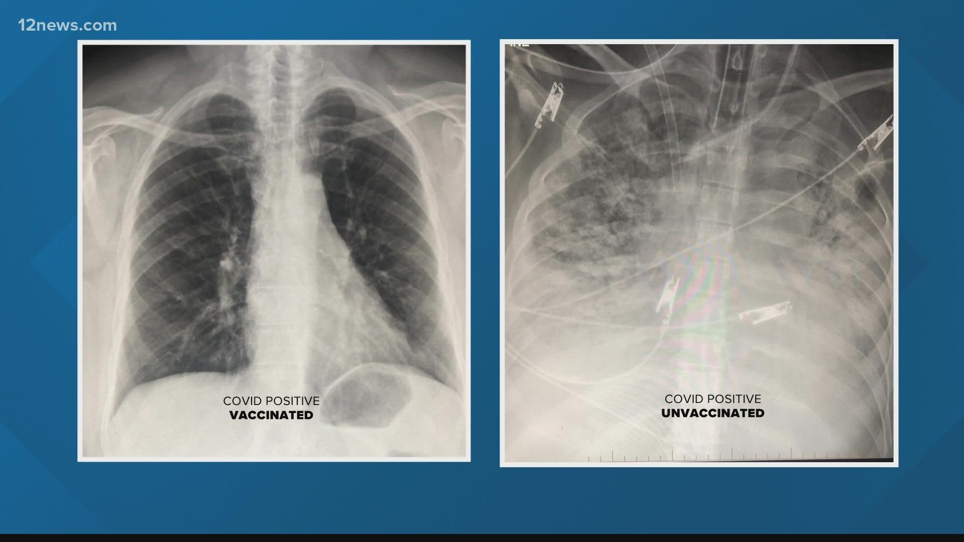 The dangers of COVID-19 are not just for new cases, some people are dealing with long-lasting effects on their lungs.
