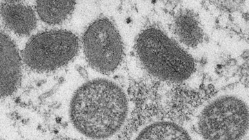 2nd presumptive case of monkeypox detected in Colorado