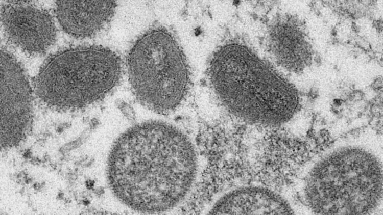 First presumptive case of monkeypox detected in Colorado