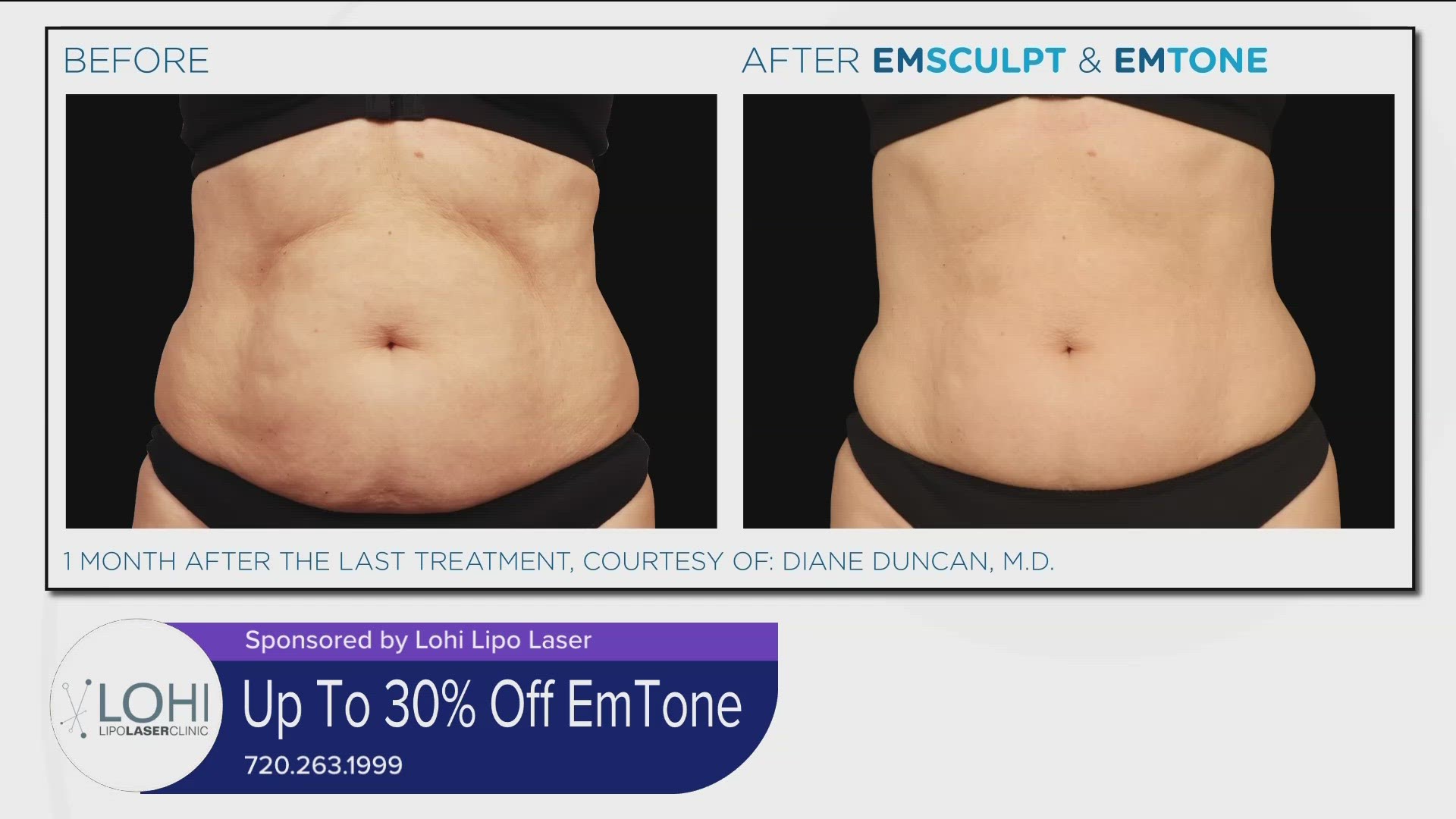 Try EmTone and get up to 30% off your treatment package. Call 720.263.1999 and schedule a free consultation. Learn more at LohiLipoLaser.com. **PAID CONTENT**