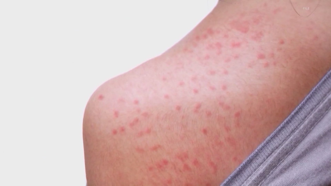 Multiple Measles Cases Confirmed in Colorado, New Jersey amid National Outbreak