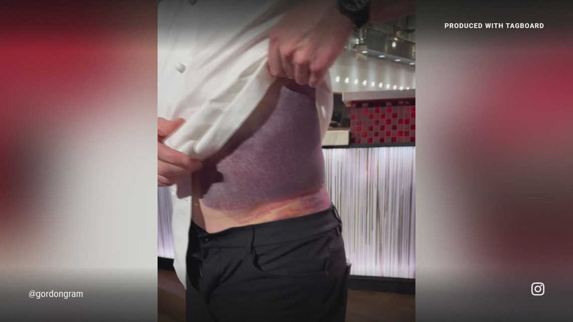 Gordon Ramsay shows massive bruise after bike accident