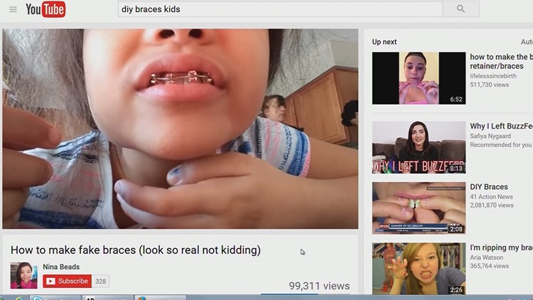 Tweens are making braces out of paper clips, rubber bands — and  predictably, it's damaging their teeth