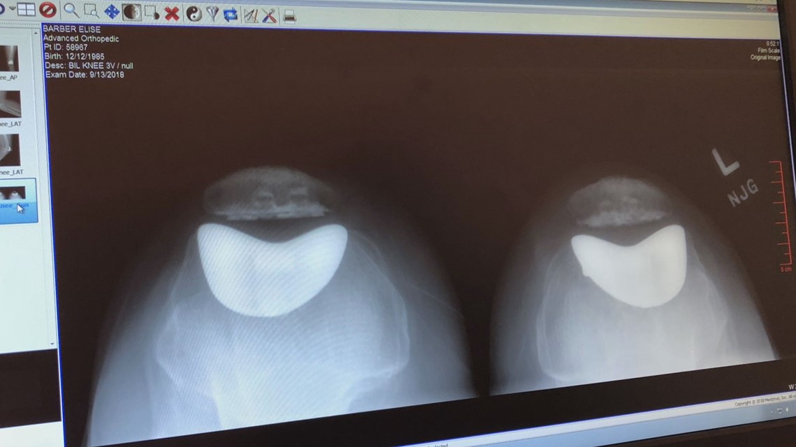 Metal allergies could lead to knee replacement complications