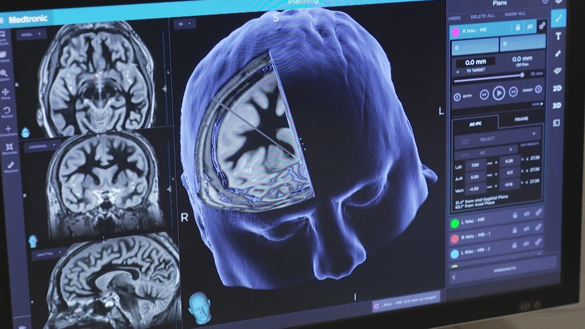 Dr. Payal Kohli talks about Parkinson's Disease and how it affects your body after Brett Favre, NFL legend, announced he was recently diagnosed with the disease.