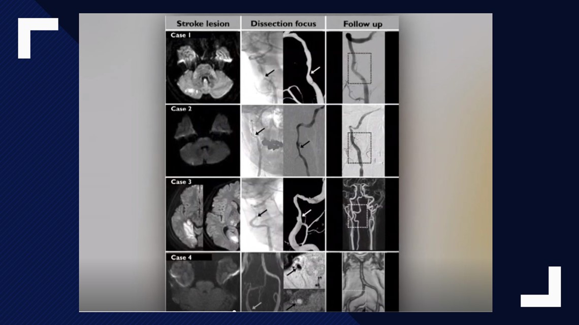 Mercy Patient Goes Viral for Stroke Caused by Popping His Neck