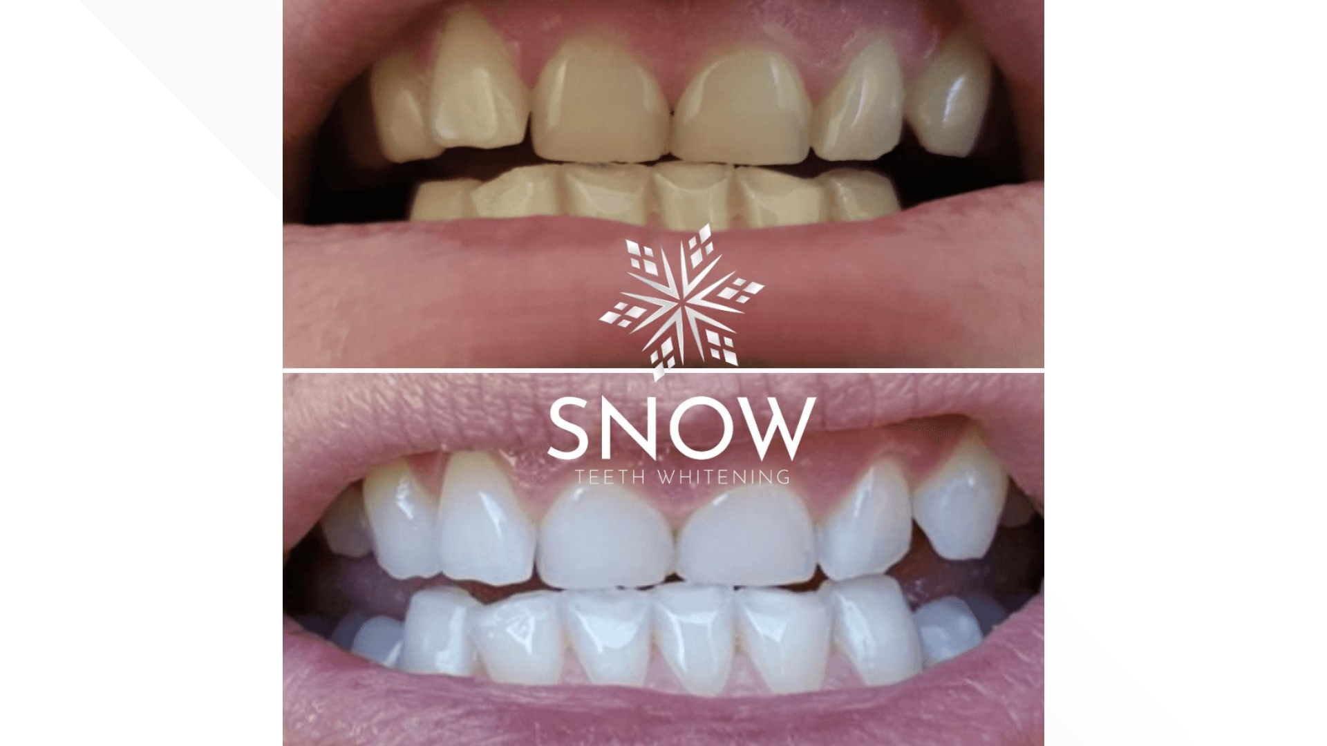 What Does Vs Snow Teeth Whitening Do?