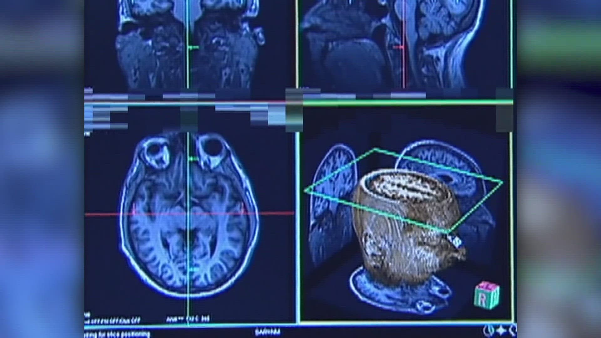 A new study has diagnosed the degenerative brain disease chronic traumatic encephalopathy (CTE) in more than 40% of youth, high school and college athletes.