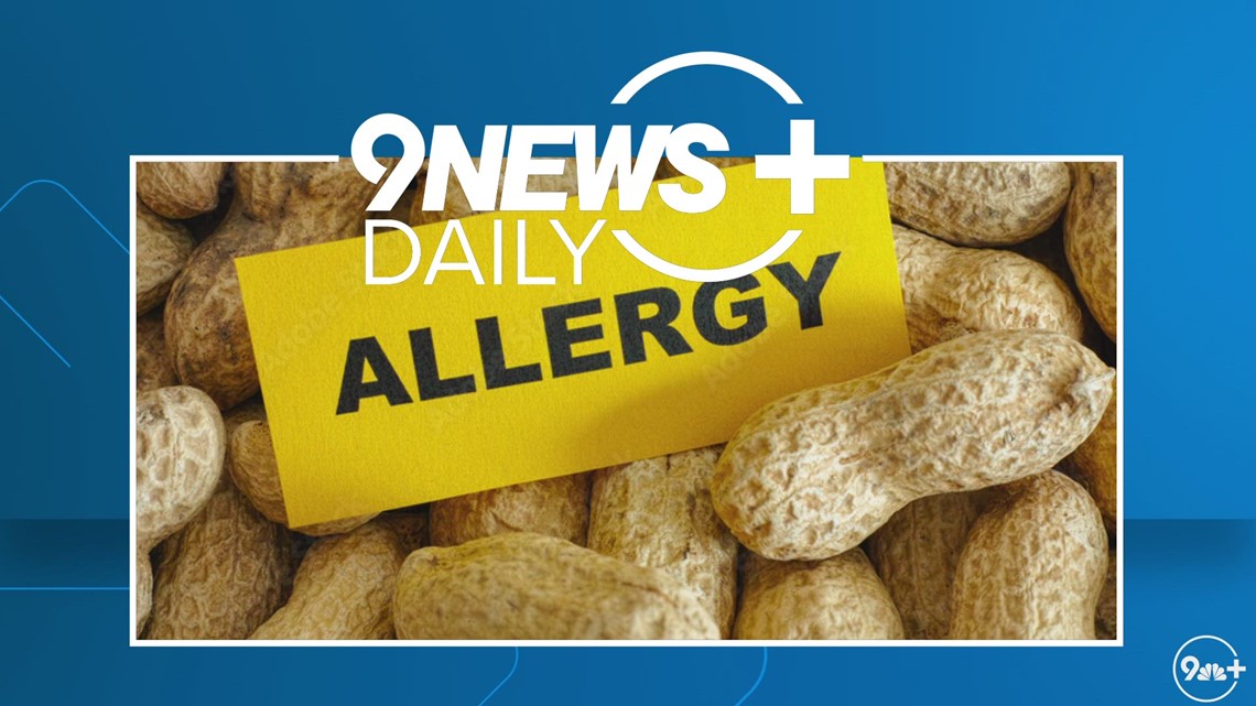 New skin patch shows promise in treating peanut allergies in kids