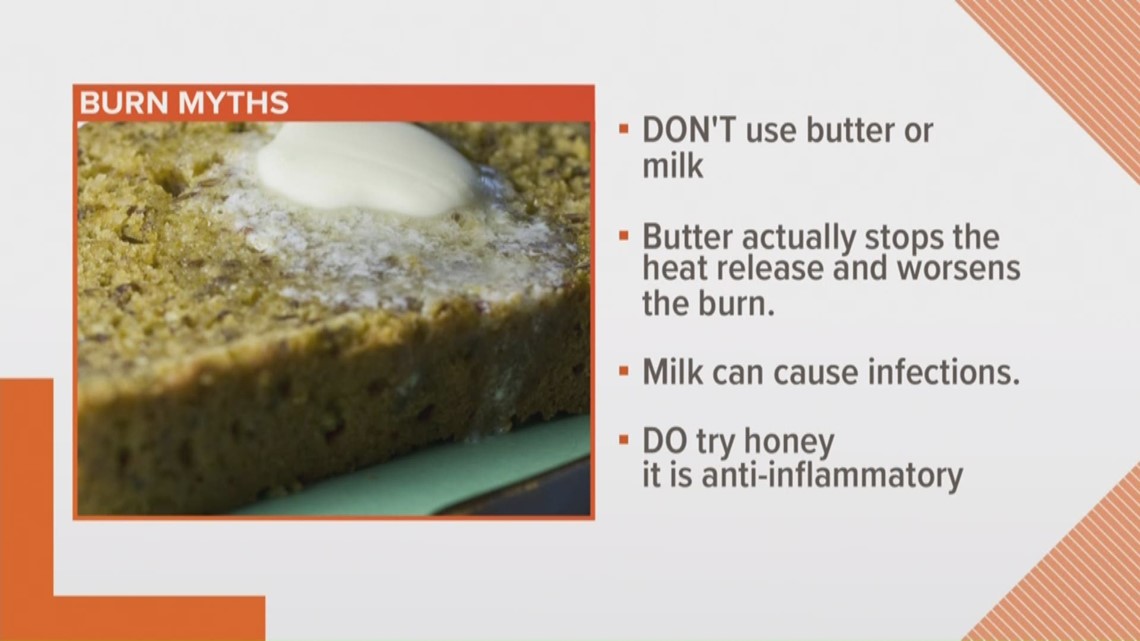 Burn myths—busted Which athome remedies really work?