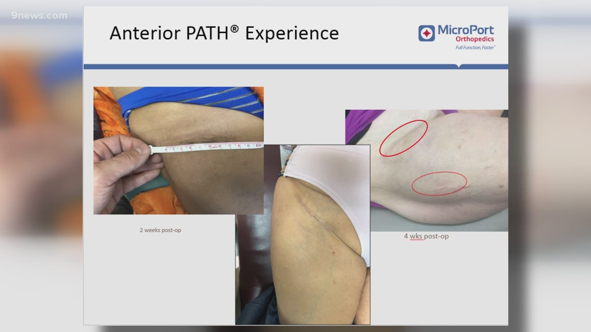 The new procedure is called PATH, which stands for Portal Assisted Total and Hip, and makes it easier to for patients to recover.