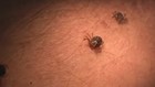 All the rain means an uptick in ticks