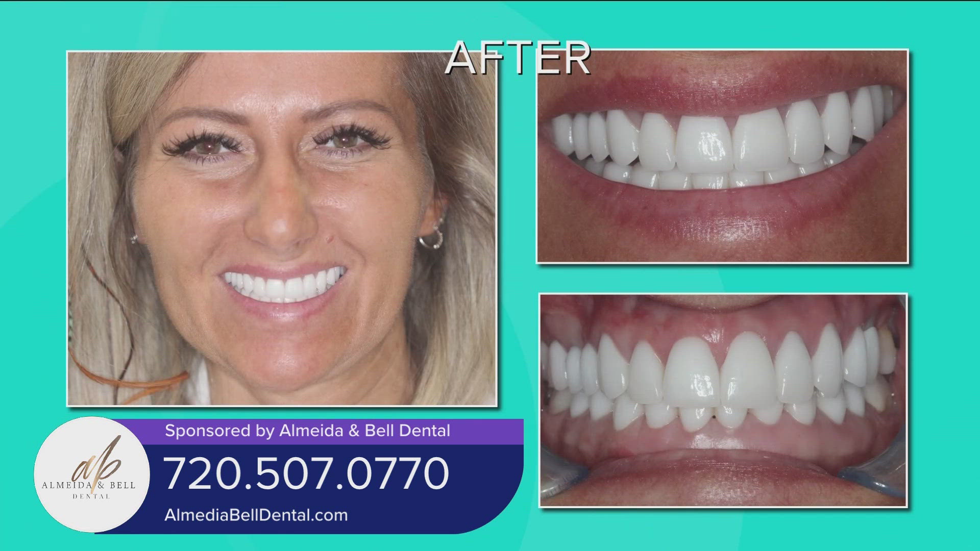 Call 720.507.0770 or visit AlmeidaBellDental.com to learn more about revitalizing your smile. You can get 25% off a Smile Makeover of 8 teeth or more! **PAID CONTENT