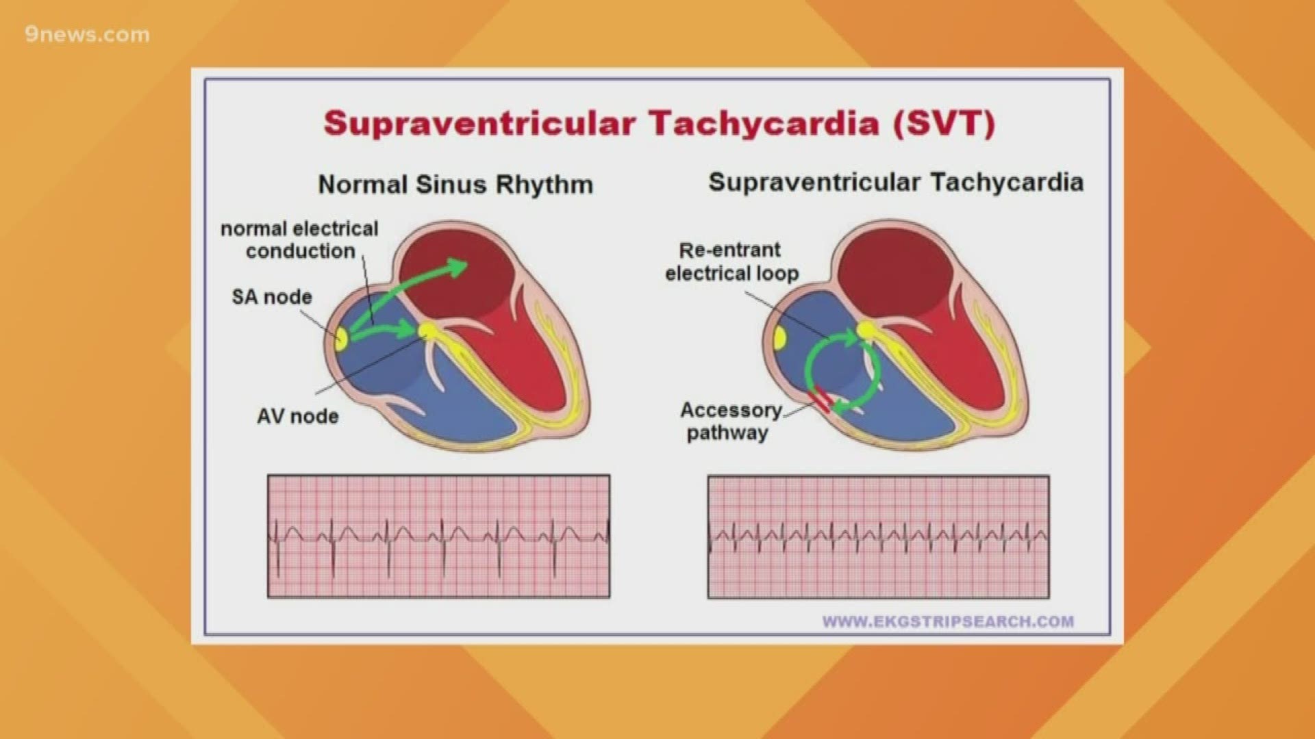SVT Is A Heart Condition That Often Affects Young Peopl 9news SVT Is A Heart Condition That Often Affects Young Peopl 9news