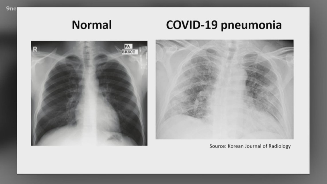 Parthenogenesis of COVID-19 infection | 9news.com