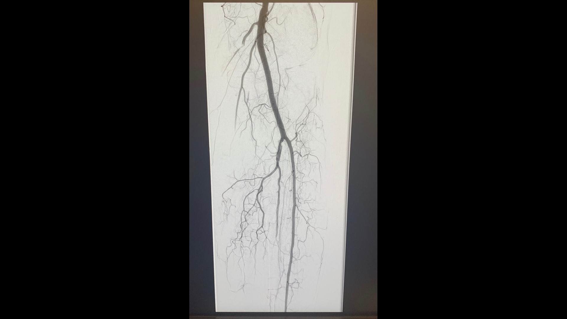 Vascular surgeon says she sees COVID19 patients with blood clots