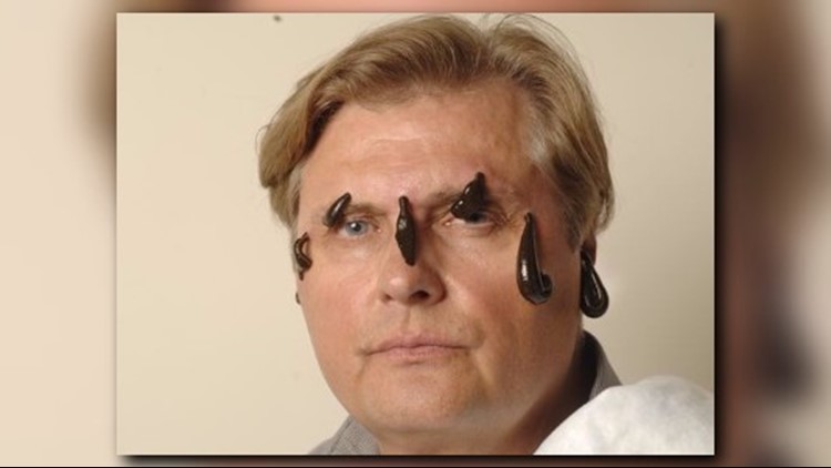 leech bite mark leech bite mark